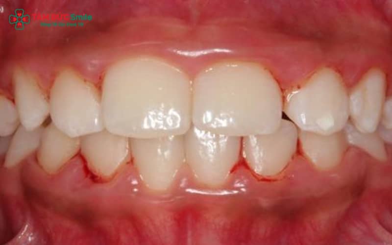Mảng bám và cao răng tích tụ do vệ sinh răng miệng kém là nguyên nhân phổ biến khiến trẻ bị viêm nha chu