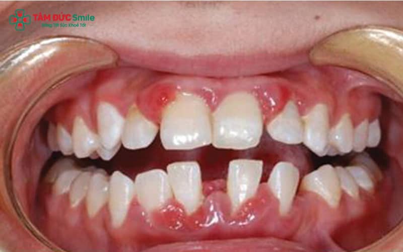 Nướu sưng đỏ, dễ chảy máu và hơi thở hôi kéo dài là dấu hiệu cảnh báo viêm nha chu ở trẻ mà cha mẹ cần chú ý