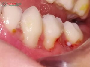 Viêm nha chu ở trẻ em: Nguyên nhân, dấu hiệu, điều trị và phòng ngừa hiệu quả