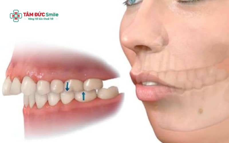 Các bài tập cho răng hô chỉ mang tính hỗ trợ, không thể thay thế hoàn toàn các phương pháp điều trị chỉnh nha chuyên sâu