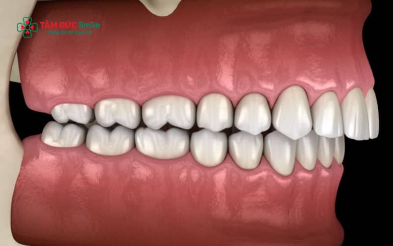 Bài tập cho răng hô thường phù hợp với trẻ em hoặc người có hô do thói quen, không hiệu quả với hô do cấu trúc xương hàm