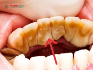 Bà bầu lấy cao răng được không? Những lưu ý khi lấy cao răng cho bà bầu