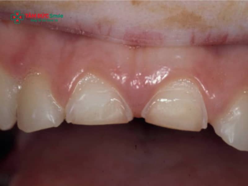 Cách khắc phục răng sữa bị mòn ở trẻ em an toàn, hiệu quả