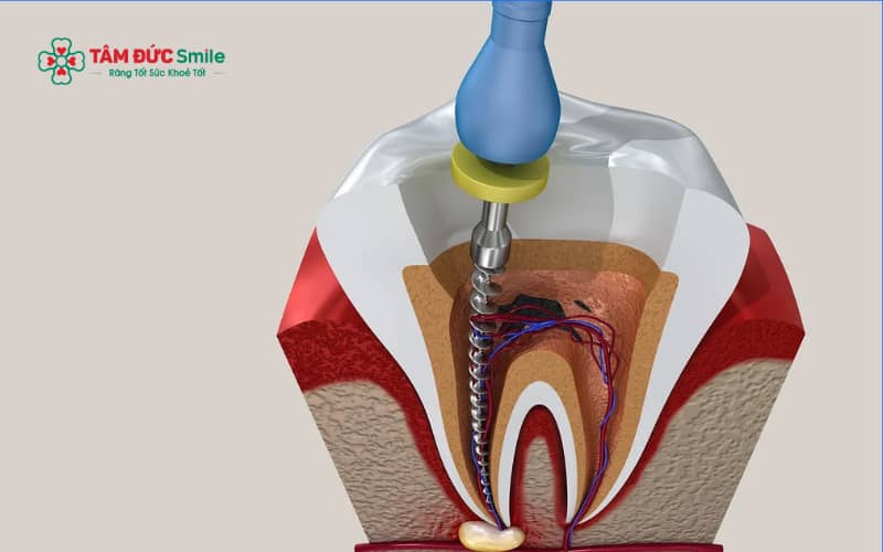 Cách làm chết tủy răng tại nhà thường được truyền miệng với mục đích giảm đau tạm thời, nhưng tiềm ẩn nhiều rủi ro cho sức khỏe răng miệng
