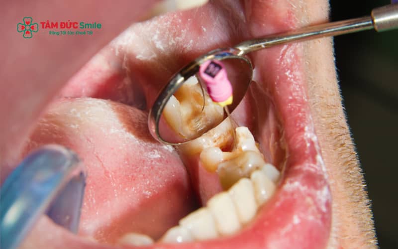 Khi răng đau kéo dài, đổi màu, có mủ hoặc hôi miệng, người bệnh cần điều trị tủy răng tại nha khoa để loại bỏ triệt để ổ viêm và bảo tồn răng