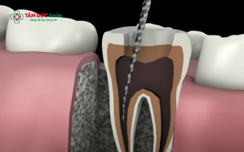 Sâu răng không điều trị, chấn thương răng hoặc can thiệp nha khoa sai kỹ thuật là những nguyên nhân phổ biến dẫn đến viêm và hoại tử tủy răng