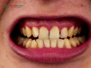 Cách làm trắng răng bị ố vàng lâu năm an toàn, hiệu quả tại nha khoa