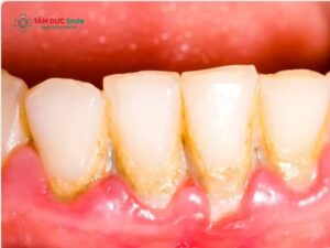 Cách lấy cao răng tại nhà bằng muối: Có hiệu quả không và lưu ý an toàn