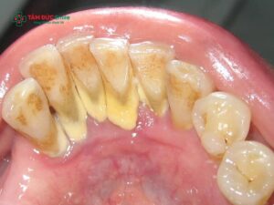 Cao răng cứng: Nguyên nhân, tác hại và cách lấy cao răng cứng an toàn