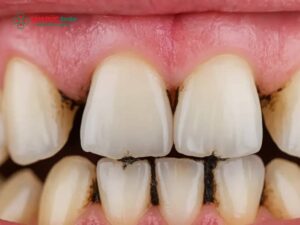 Cao răng lâu năm: Dấu hiệu nhận biết, tác hại và phương pháp xử lý cao răng lâu năm