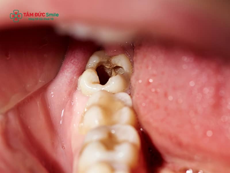 Chết tuỷ răng có nguy hiểm không? Dấu hiệu, biến chứng và cách điều trị