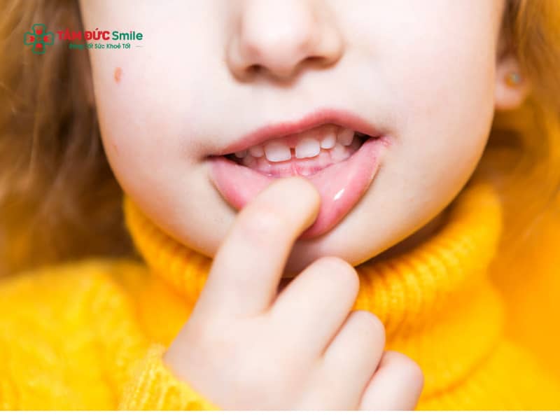 Dấu hiệu bé bị hô răng: Nhận biết sớm răng hô ở trẻ em & cách xử lý