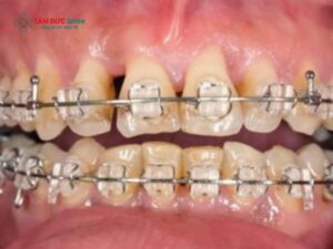 Dây thun niềng răng bị vàng: Nguyên nhân, ảnh hưởng & cách xử lý hiệu quả