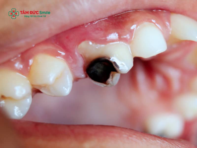 Diệt tủy răng là gì? Khi nào cần diệt tủy, quy trình và chăm sóc răng sau khi diệt tủy