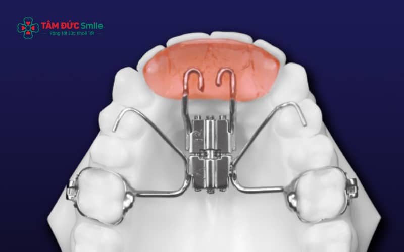 Dụng cụ chỉnh nha là các khí cụ nha khoa được thiết kế nhằm sắp xếp răng và điều chỉnh khớp cắn về đúng vị trí