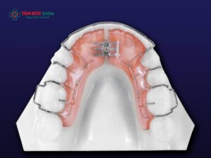 Dụng cụ chỉnh nha: Các loại khí cụ chỉnh nha phổ biến và cách lựa chọn phù hợp