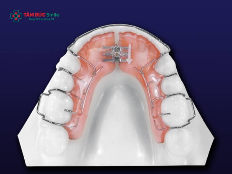 Dụng cụ chỉnh nha: Các loại khí cụ chỉnh nha phổ biến và cách lựa chọn phù hợp