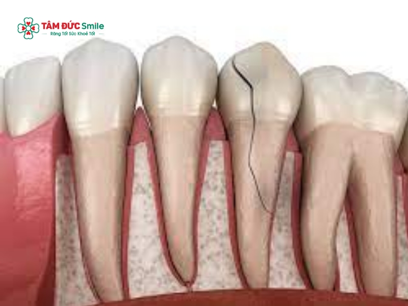 Gãy chân răng có nguy hiểm không? Các phương pháp điều trị và phòng ngừa