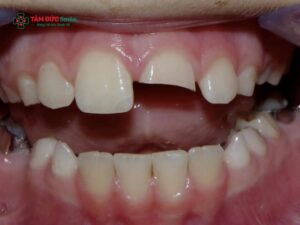 Gãy nửa răng cửa có nguy hiểm không? Cách phục hồi răng cửa thẩm mỹ