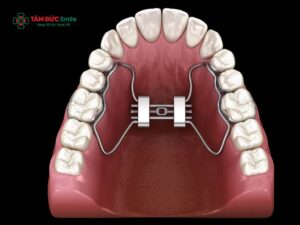 Hàm tiền chỉnh nha cho trẻ em là gì? Lợi ích, thời điểm và phương pháp