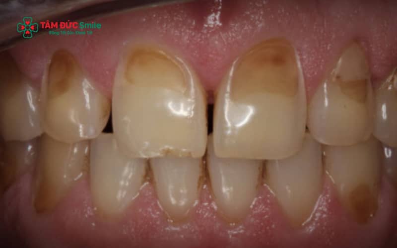 Hỏng men răng là tình trạng lớp men bảo vệ bên ngoài răng bị mòn, nứt hoặc tổn thương, làm răng yếu đi và dễ ê buốt, sâu răng hơn