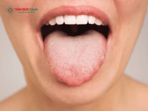Lưỡi trắng là bệnh gì? Nguyên nhân, cách điều trị và phòng ngừa