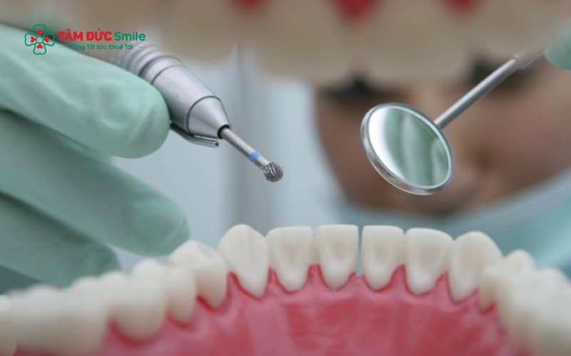 Mài răng cửa là kỹ thuật loại bỏ một lớp men răng rất mỏng nhằm điều chỉnh hình thể răng hoặc chuẩn bị cho phục hình thẩm mỹ