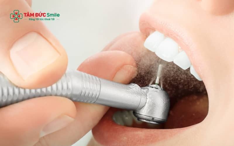 Mài răng cửa thường được chỉ định trong các trường hợp răng lệch nhẹ, răng quá to, chìa nhẹ hoặc hình thể không cân đối