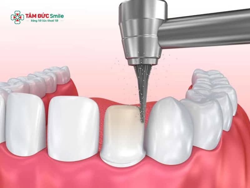 Những trường hợp nên thực hiện mài răng cửa? Mài răng cửa cần lưu ý gì?