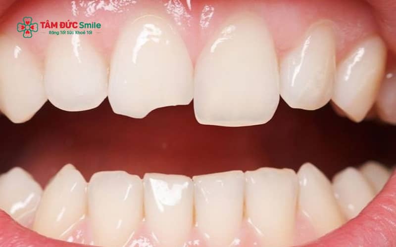Răng cửa dễ bị mẻ do tai nạn sinh hoạt, thói quen cắn vật cứng, sâu răng làm yếu men răng hoặc nghiến răng kéo dài khi ngủ