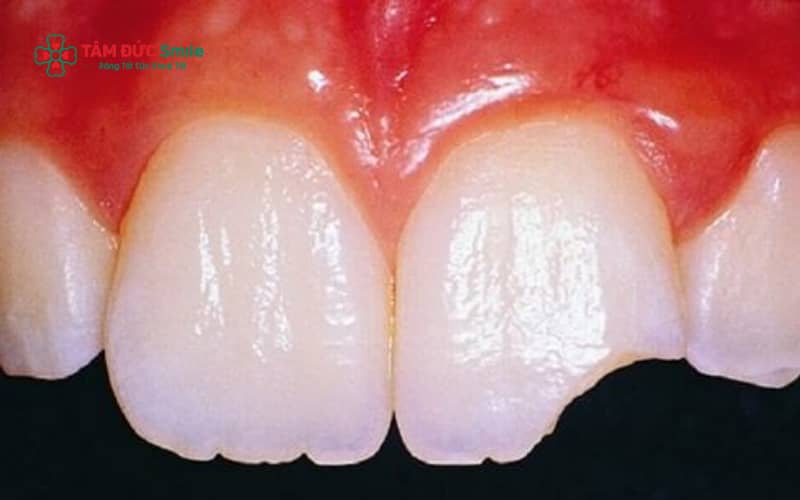 Mẻ răng cửa không chỉ ảnh hưởng đến thẩm mỹ khuôn mặt mà còn gây suy giảm chức năng ăn nhai, phát âm