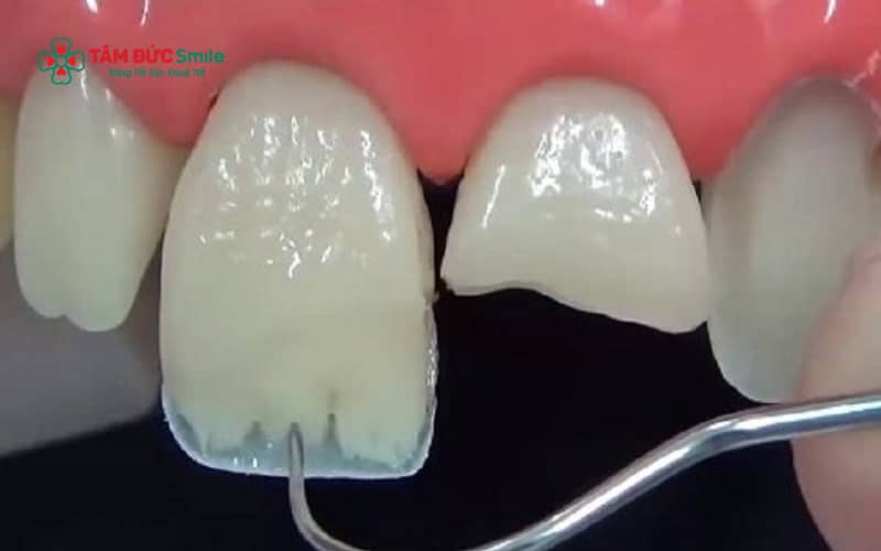 Tùy mức độ mẻ răng cửa, bác sĩ có thể chỉ định trám răng