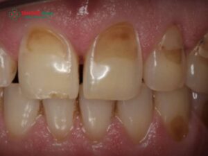 Men răng yếu: Dấu hiệu, nguyên nhân và phương pháp điều trị
