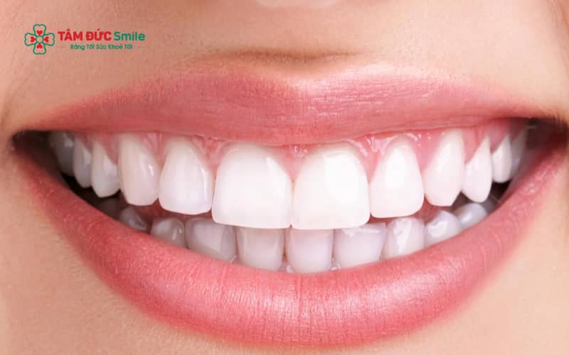 Hiệu quả làm trắng răng trong 5 phút thường chỉ mang tính tạm thời và phụ thuộc vào tình trạng răng cũng như phương pháp áp dụng