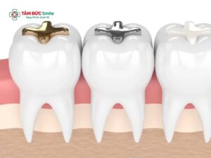 Mới trám răng có được đánh răng không? Lưu ý sau khi trám răng