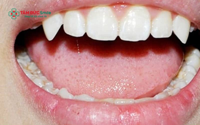 Răng trâu có thể làm mất cân đối nụ cười, ảnh hưởng đến thẩm mỹ khuôn mặt nếu kích thước răng quá lớn so với cung hàm