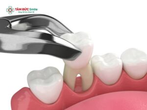 Nhổ răng cấm có nguy hiểm không? Những biến chứng có thể gặp khi nhổ răng cấm