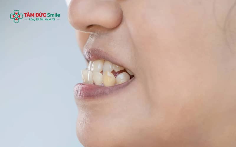 Niềng răng móm có thể gây cảm giác ê và căng tức trong những ngày đầu, nhưng mức độ đau thường nhẹ và nằm trong ngưỡng chịu đựng được