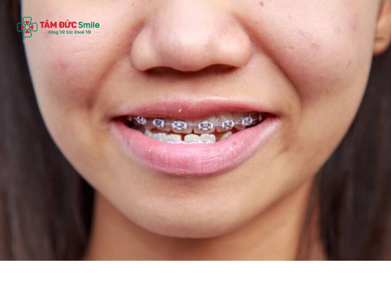 Niềng răng móm có đau không? Cách giảm đau khi niềng răng móm hiệu quả