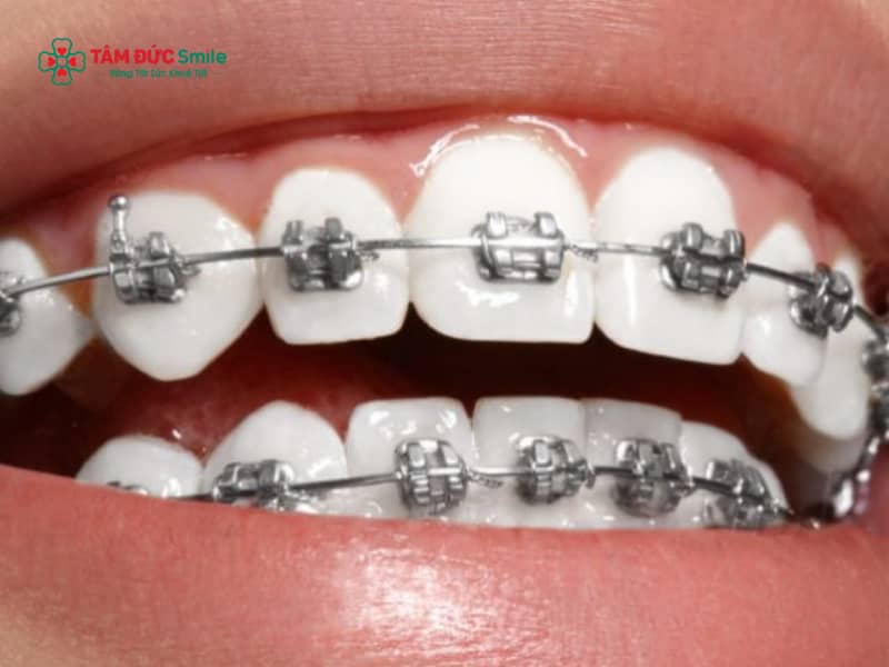 Niềng răng xong bị móm​: Dấu hiệu, nguyên nhân, cách giải quyết