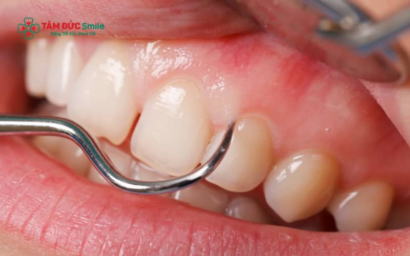 Nướu răng bị trắng có thể xuất phát từ viêm nướu, nhiễm nấm, thiếu máu hoặc các bệnh lý toàn thân ảnh hưởng đến sức khỏe răng miệng