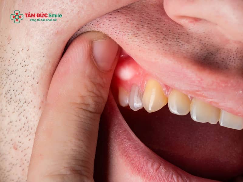 Nướu răng bị trắng là gì? Nguyên nhân và cách điều trị an toàn