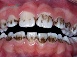Răng có vết đen: Nguyên nhân và cách xử lý