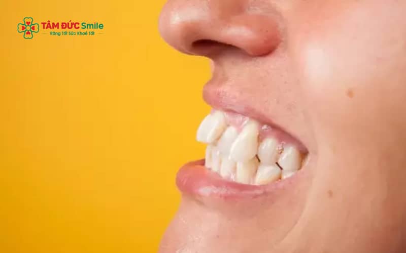 Răng hô cằm lẹm là tình trạng răng hàm trên nhô ra kết hợp với cằm trông lẹm, khiến khuôn mặt mất cân đối và ảnh hưởng nụ cười