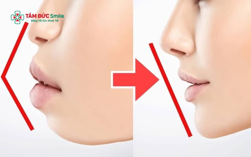 Tùy mức độ răng hô và cấu trúc hàm, bác sĩ có thể chỉ định niềng răng mắc cài, niềng răng trong suốt Invisalign hoặc phẫu thuật chỉnh hàm trong trường hợp nặng