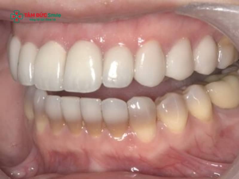 Răng nhiễm tetracycline là gì? Dấu hiệu, mức độ và cách điều trị hiệu quả