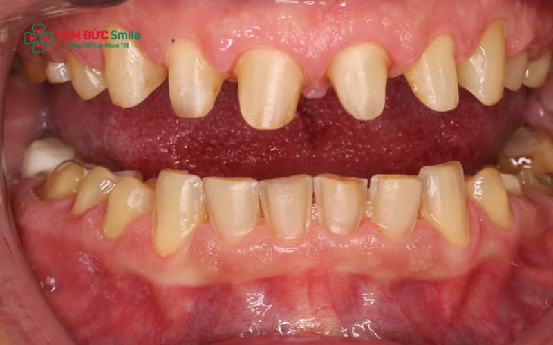 Răng nhỏ có thể xuất phát từ yếu tố di truyền, thiếu dưỡng chất trong giai đoạn phát triển răng hoặc chịu ảnh hưởng từ bệnh lý và môi trường