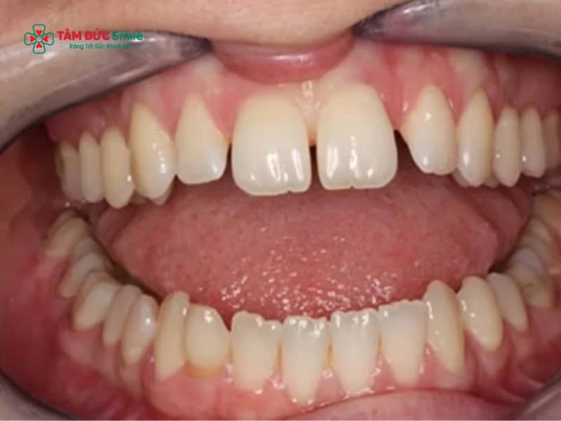Răng nhỏ là gì? Nguyên nhân và cách khắc phục hiệu quả