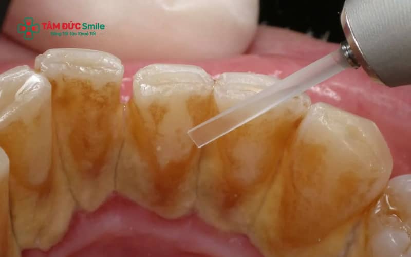 Lấy cao răng giúp làm sạch mảng bám, trong khi các phương pháp điều trị răng ố vàng giúp cải thiện màu răng an toàn và hiệu quả.