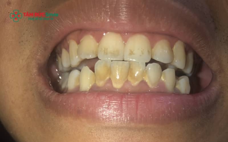 Răng ố vàng kèm cao răng thường xuất phát từ thói quen ăn uống, vệ sinh răng miệng chưa đúng cách và không lấy cao răng định kỳ